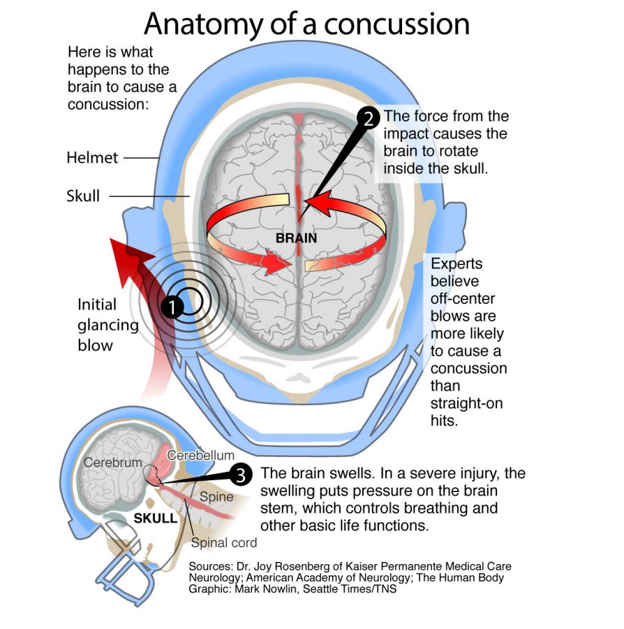 Infographic showing what happens during a concussion. Seattle Times 2016